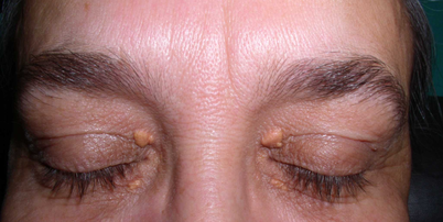Manchas e protuberâncias amareladas nos olhos são chamadas de xantelasma Foto: Wikimedia