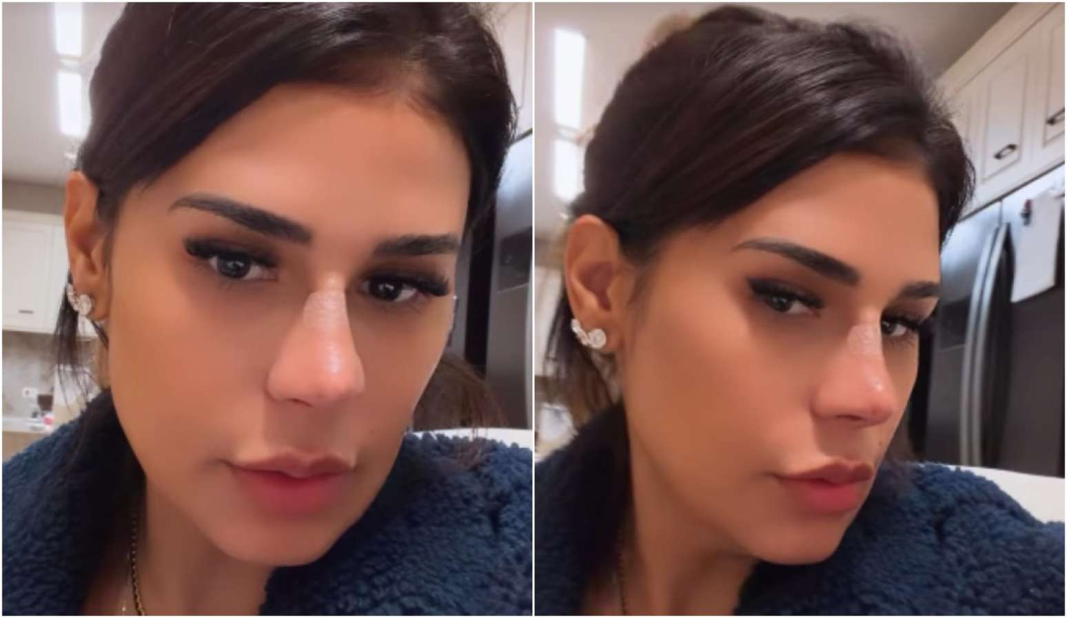 Simone Mendes mostra resultado ap&oacute;s procedimento no nariz